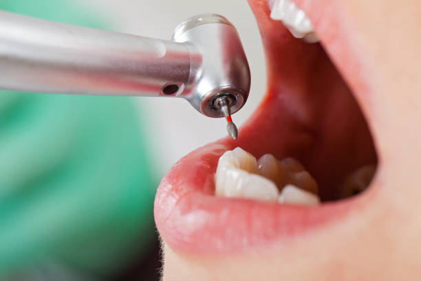 Best Same-Day Emergency Dental Services in Montz, LA